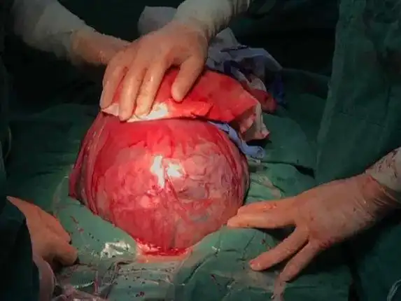 此次妊娠为前置胎盘,且胎盘附着于原子宫切口瘢痕处,并常伴有胎盘植入