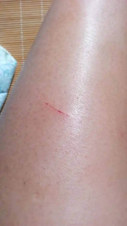 被狗狗抓到了的皮肤局部会有什么样的变化