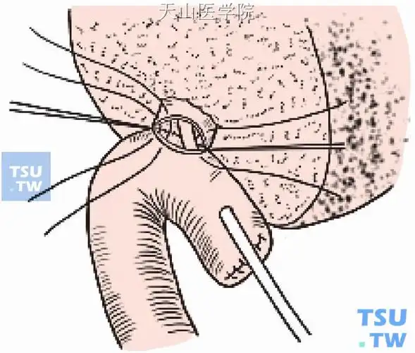 肝管空肠roux-en-y吻合