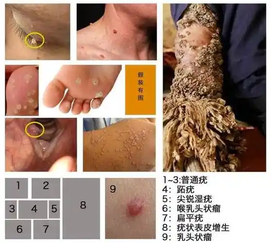 所以日常生活中如果接触到患病皮肤或沾有病毒的器物就有可能被感染
