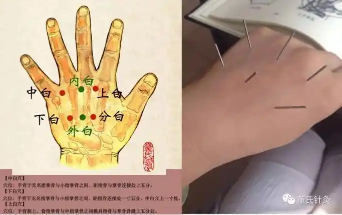 手六,手千金,手五金】临床上全部对侧取穴董氏针灸坐骨神经痛处方