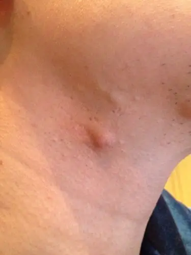 耳朵后边的皮脂腺囊肿图片