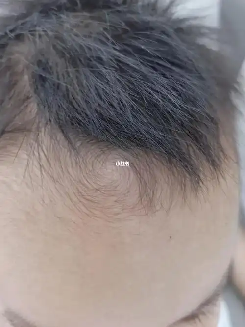 有同款旋风仔吗额头中心带旋儿