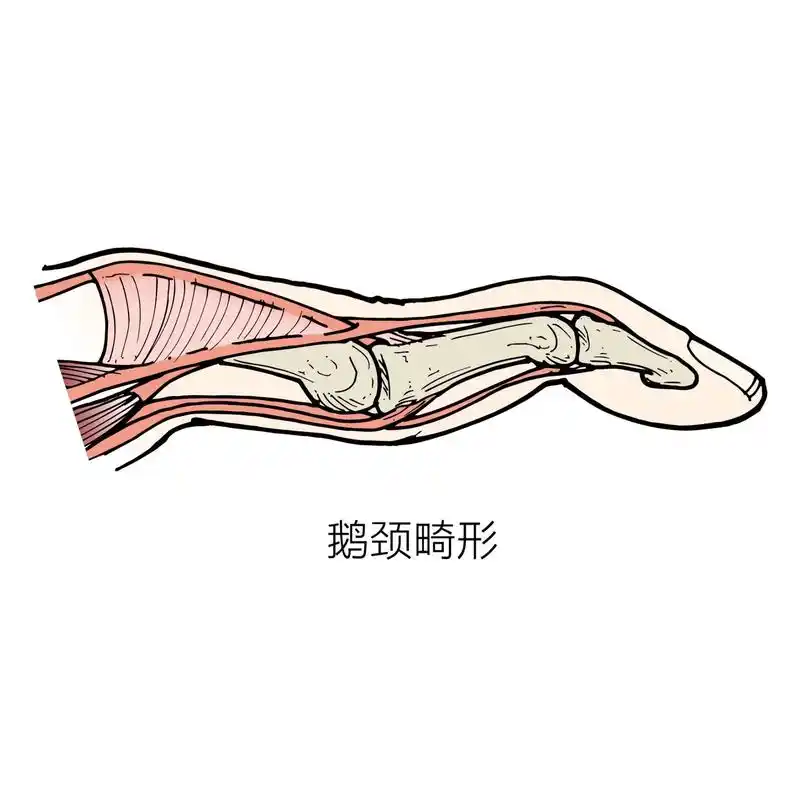 天鹅颈畸形 11566特征:近侧指间关节过伸,远侧指 - 抖音