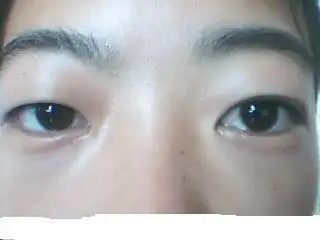 眼球会有点突出怎么办?