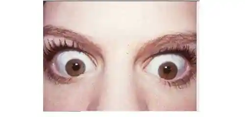 长期戴眼镜眼球会突出 如何预防才有效?