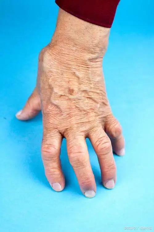 脉管炎是什么症状吃什么药