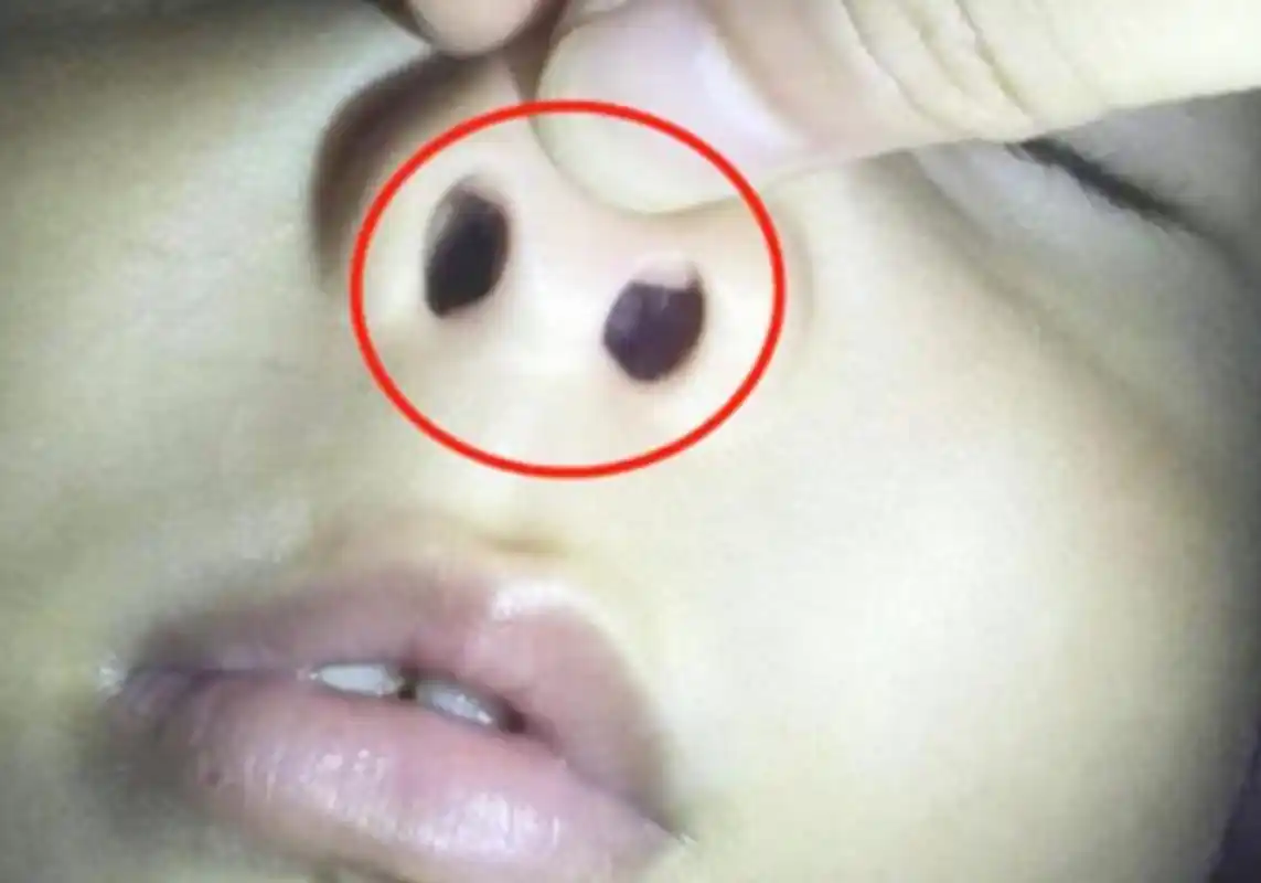 专家:逃不掉几种结局_鼻腔