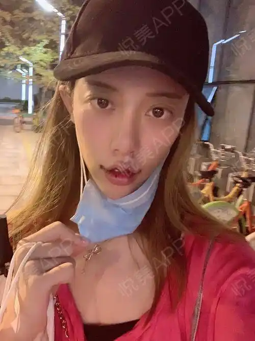 嘴角上扬术术后2天_m唇手术术后2天_唇型美化术后2天_口唇整形术后2天