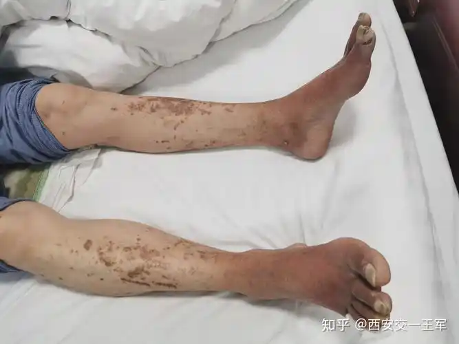 12年前,谢先生查出糖尿病,一直进行血糖控制,慢慢下肢皮肤的颜色开始