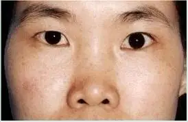 鹿鼻鼻丰而整,但无鼻梁,准头圆满,颜色鲜润,主为人平和,不逞强好胜,心