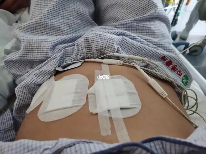 宫外孕术后第二天,排气,下床活动