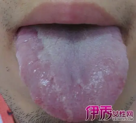 【图】盘点舌头溃烂图片 教你中医治疗法