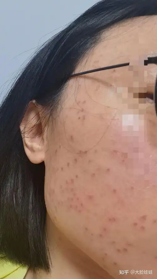 射频治疗扁平疣