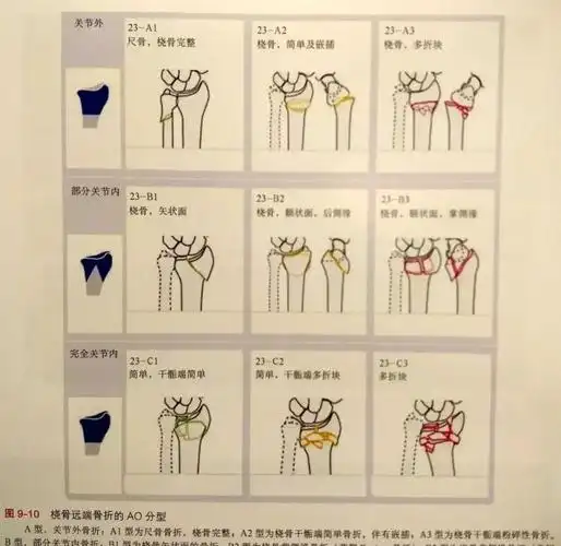 关于四肢骨折的分型看这篇就够了