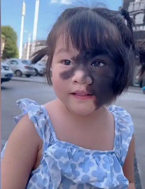 令人心疼的兽皮痣患者,小小年纪辗转各大医院,父母却遭网友质疑