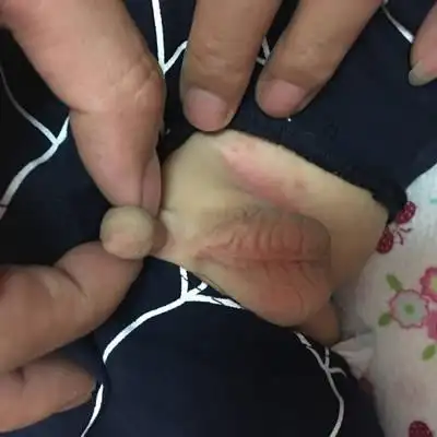 宝宝10多天前垫尿不湿捂的红屁屁,有10多天没有垫