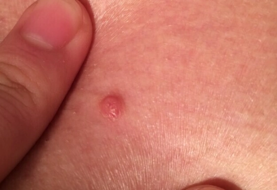 梅毒前期小红点图片 (13)