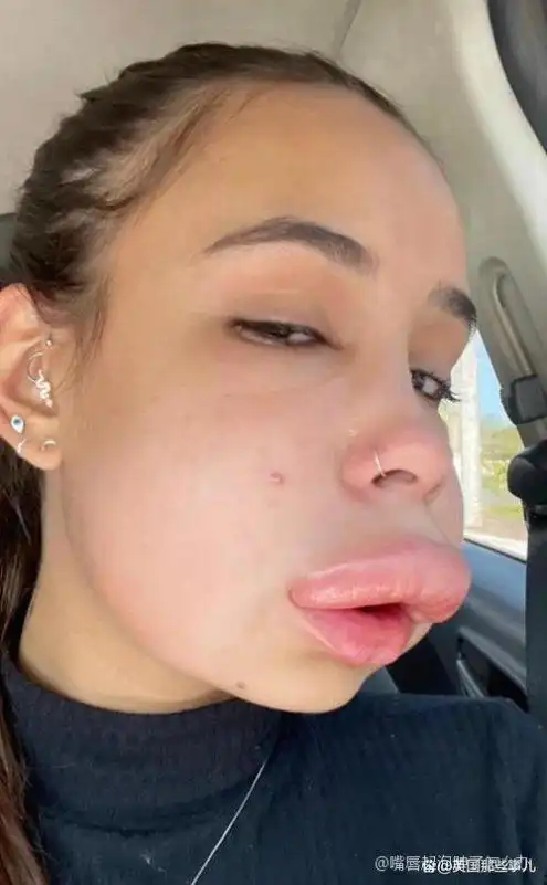 嘴唇起泡肿了怎么办(嘴唇起泡肿了要怎么处理) - 综合百科 - 绿润百科