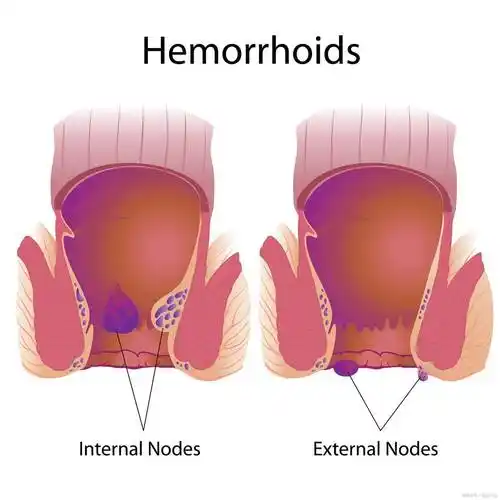 痔疮出血,你可以这样紧急处理!_穴位_肠道_肛门