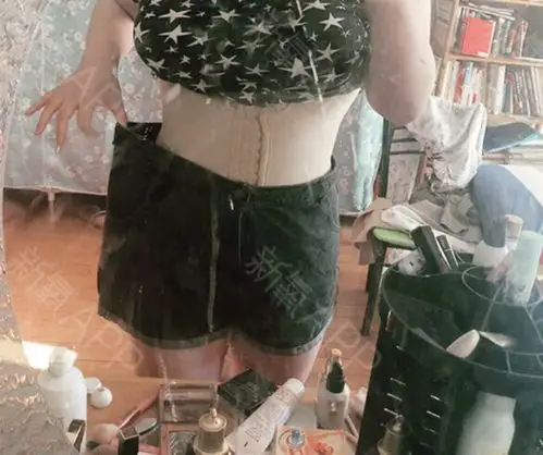 在施尔美做的腰腹环吸已经快一个月了,我真的瘦了很多_圈子-新氧美容