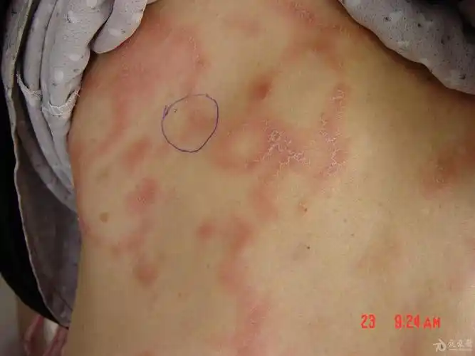 私人-珍藏-蕈样肉牙肿图片