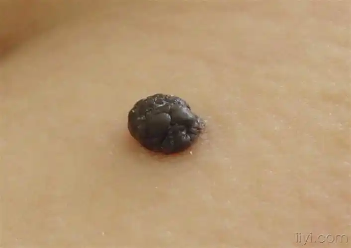 门诊图片8皮内痣