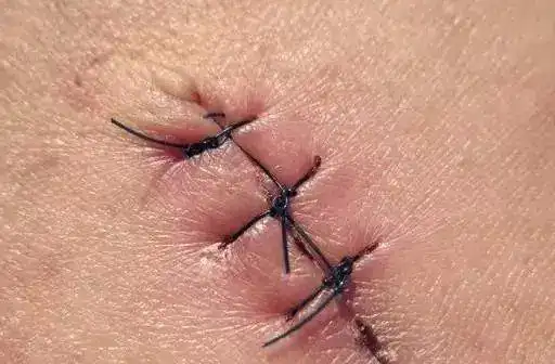 顺产时自然撕裂与侧切有什么不同产科医生给你解答