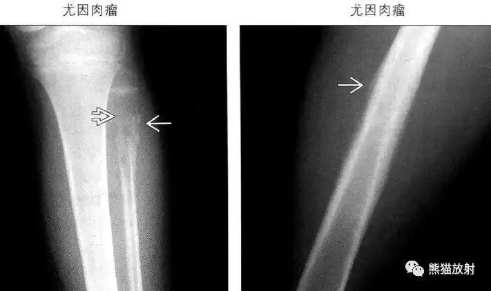 骨膜侵袭性骨膜炎丨鉴别诊断