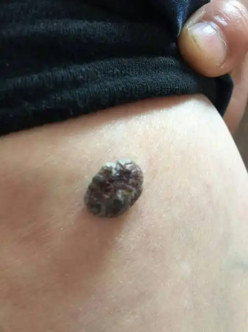 恶良性黑色素瘤早期