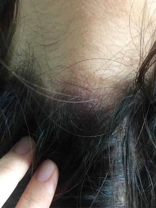 头皮上脂溢性皮炎和毛囊炎共生多年你们有根治的么一起交流一下吧