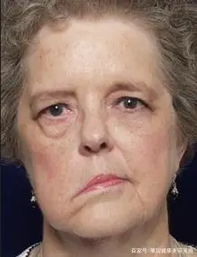 面瘫患者表现为口眼斜,做表情更明显