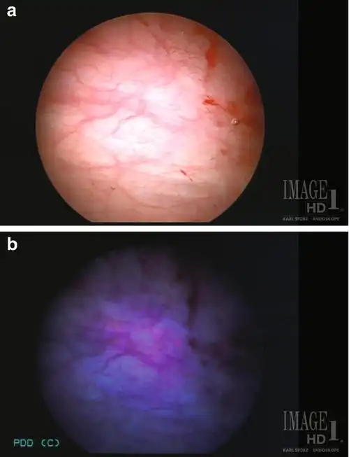 膀胱癌的镜检技术的进步