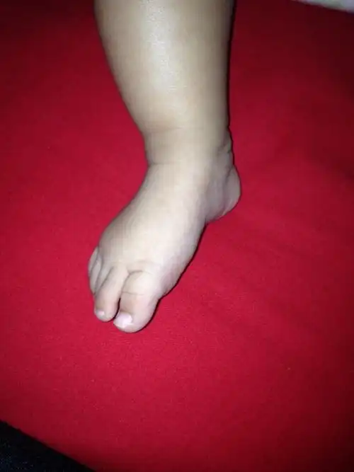 小宝的脚出生就外翻,现在这样严重不