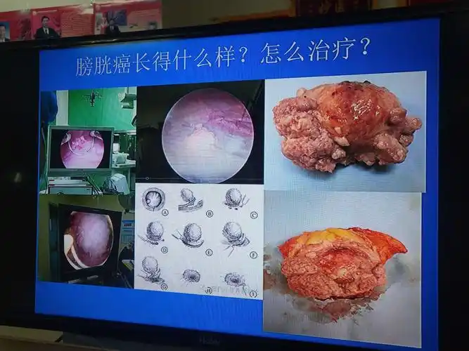 今日学习膀胱癌的灌注化疗(2020.1.8)