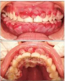 妊娠期多发性牙龈瘤1例