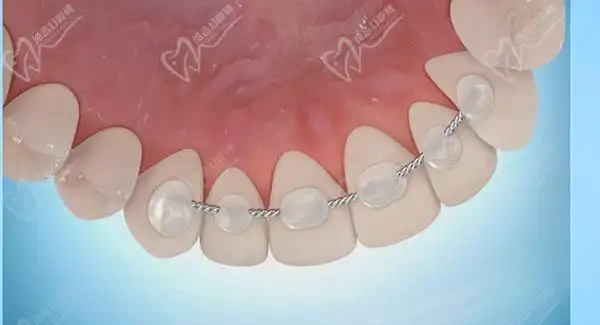 颜色透明(类似于隐形矫正的牙套一样,但是不同于隐形牙套,透明保持器