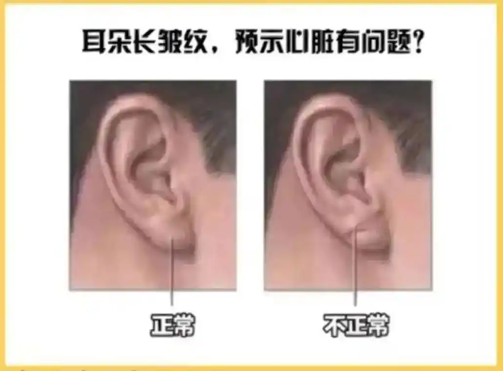 耳朵上有这条折痕,是心梗,猝死的"标志"?为什么?