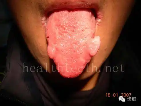 舌息肉,该患者同时伴有胃,食管息肉,后来看内科了,具体情况不详