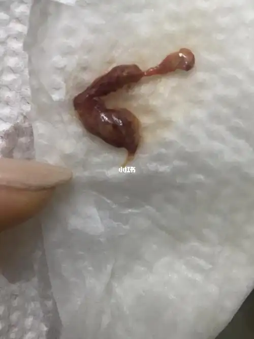 药流一星期基本没流血 八天复查残留两厘米 医生说清宫 我拒绝 其实