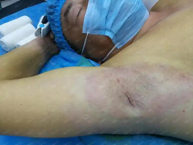 注射去狐臭好不好_效果图_昆明云医大医院腋臭科注射去狐臭术后第33天