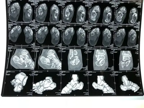 跟骨骨折追求的治疗目标:皮瓣安全,恢复跟骨高度,宽度,纠正内翻,恢复