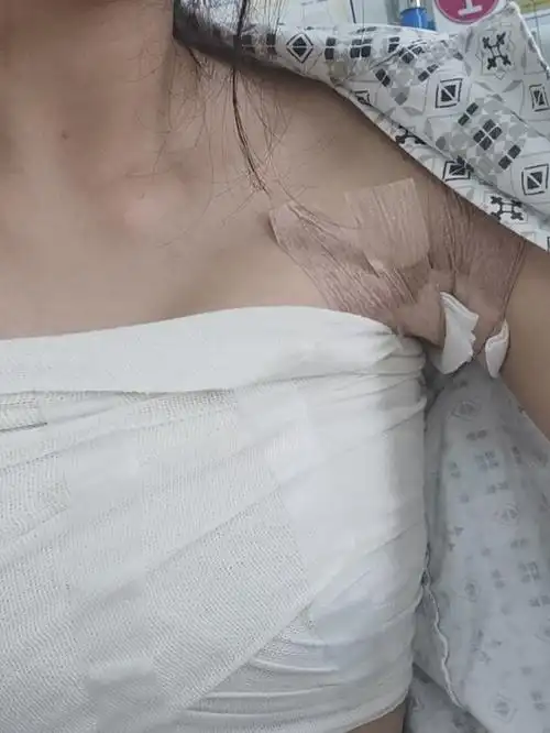 手术是在腋下切口的,做完手术到现在,静养了差不多有_圈子-新氧美容