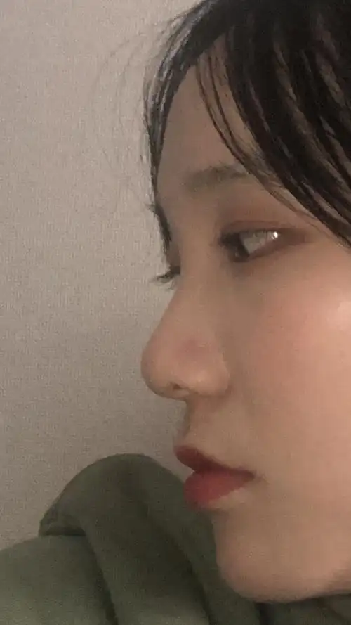 很肿,并且看被鼻梁挡住的那一只眼睛,已经凸出来了