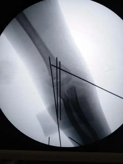 刘道禹肱骨髁上骨折