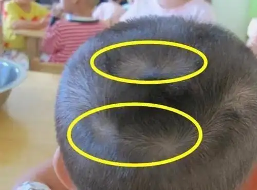 为什么有的孩子头上有"2个旋"?代表什么意思,父母要知道_宝宝