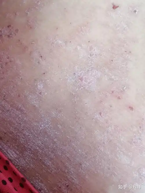 牛皮癣治愈一例