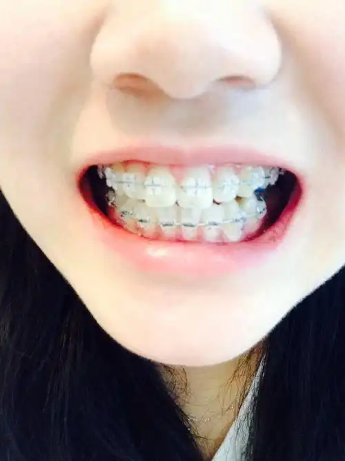 牙齿不齐一直是我的烦恼,关键是门牙突出来嘴巴也有点突出来笑的时候