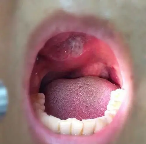 【讨论】【查体】右侧鼻面部显肿胀,右侧鼻腔内可见淡红色粗糙肿物,与