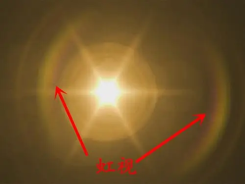 青光眼虹视图片